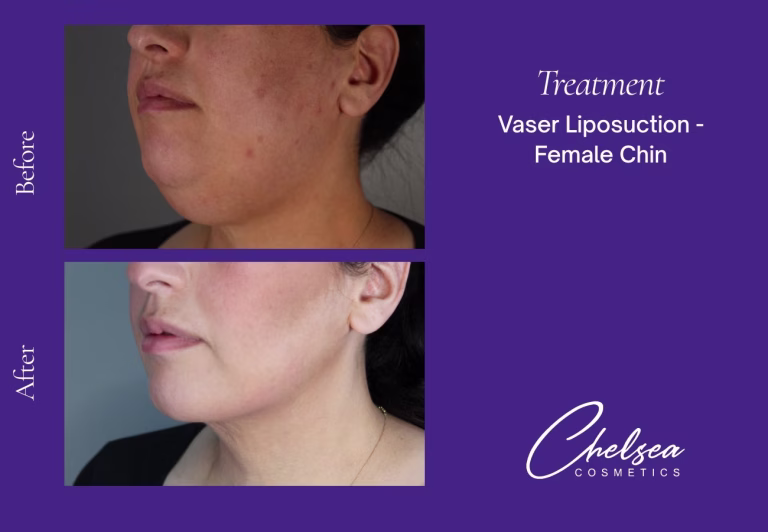 Chin Treatment — Chelsea Cosmetics Melbourne