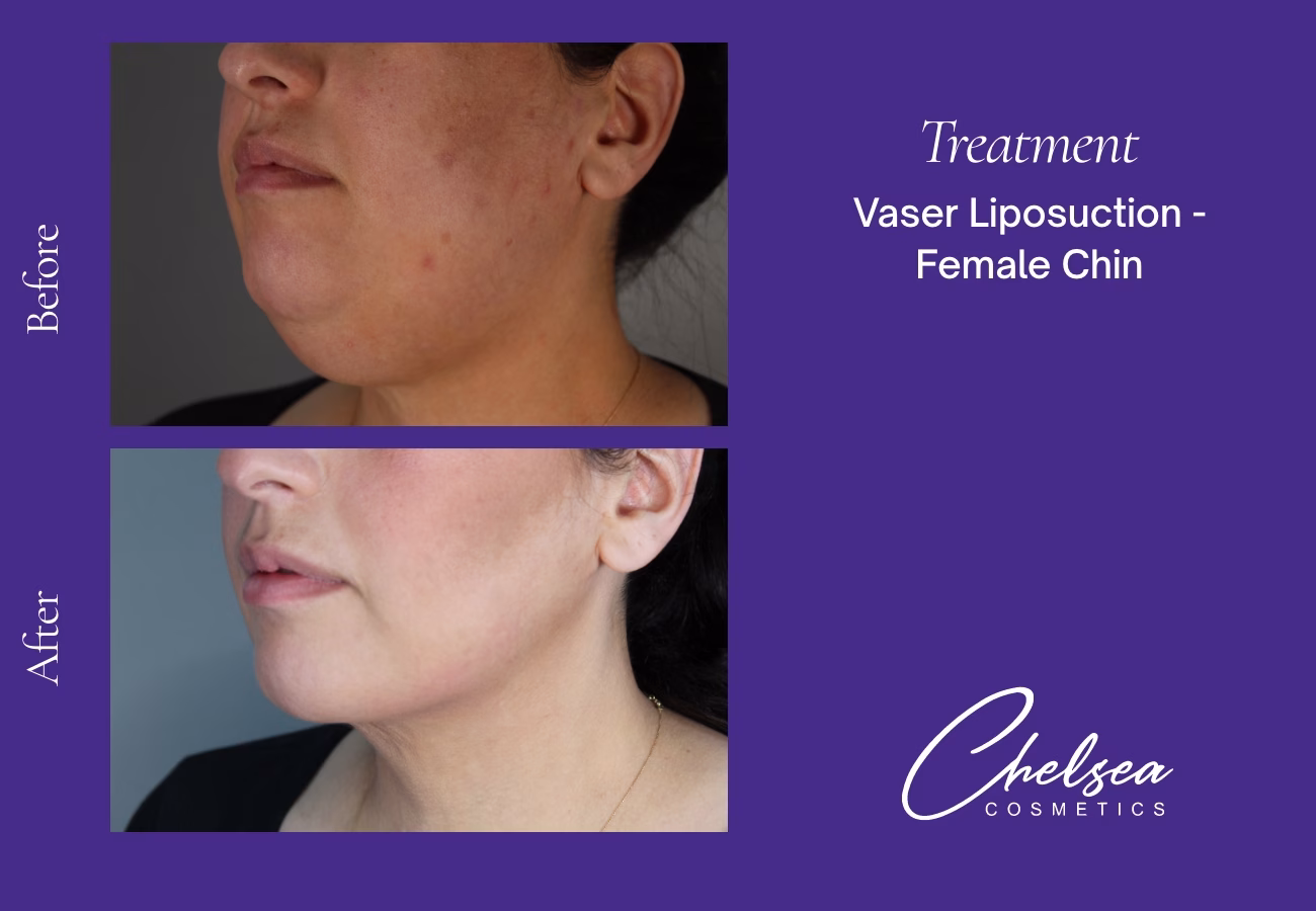 Chin Treatment — Chelsea Cosmetics Melbourne