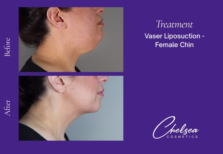 Chin Treatment — Chelsea Cosmetics Melbourne