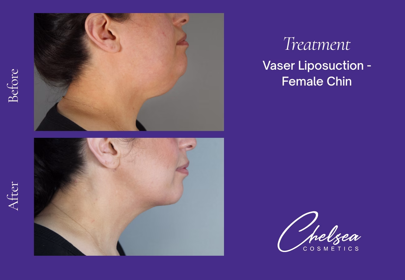 Chin Treatment — Chelsea Cosmetics Melbourne