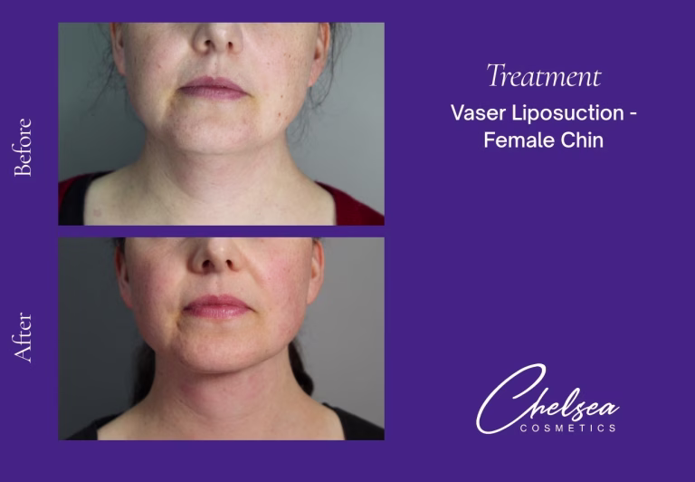Chin Treatment — Chelsea Cosmetics Melbourne