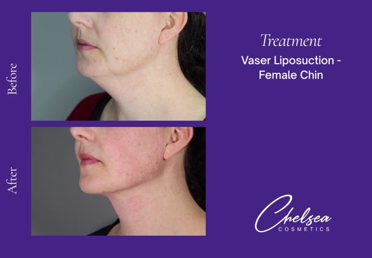 Chin Treatment — Chelsea Cosmetics Melbourne