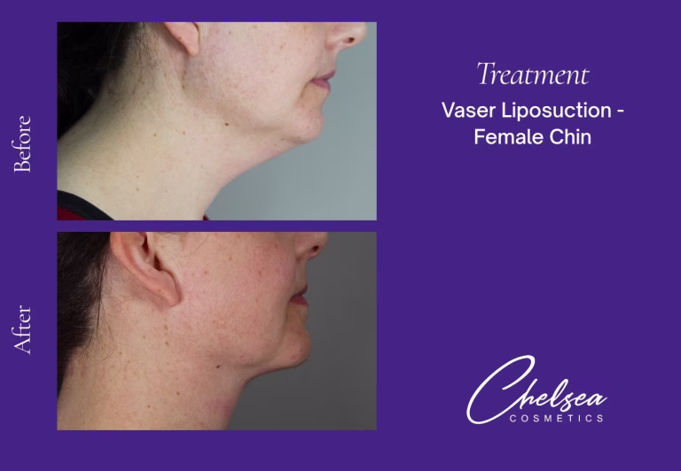 Chin Treatment — Chelsea Cosmetics Melbourne