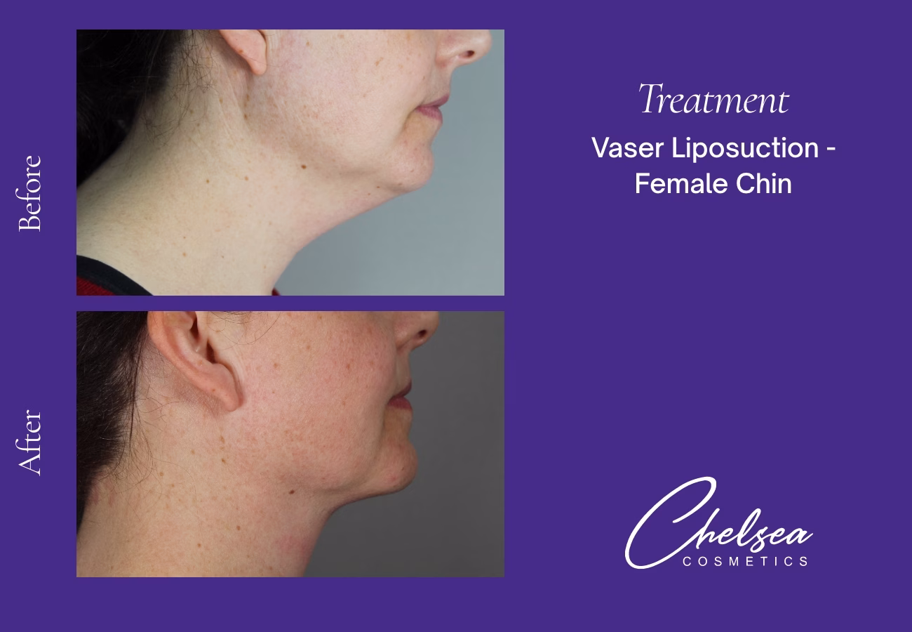 Chin Treatment — Chelsea Cosmetics Melbourne
