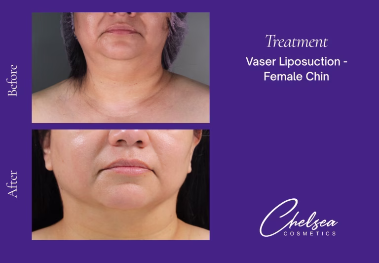 Chin Treatment — Chelsea Cosmetics Melbourne