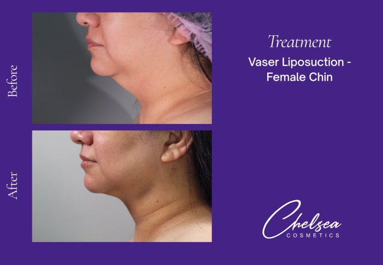 Chin Treatment — Chelsea Cosmetics Melbourne