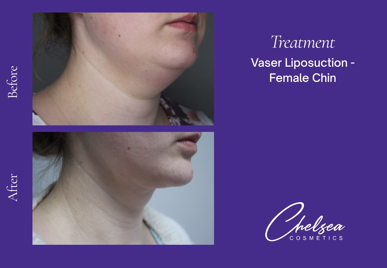 Chin Treatment — Chelsea Cosmetics Melbourne