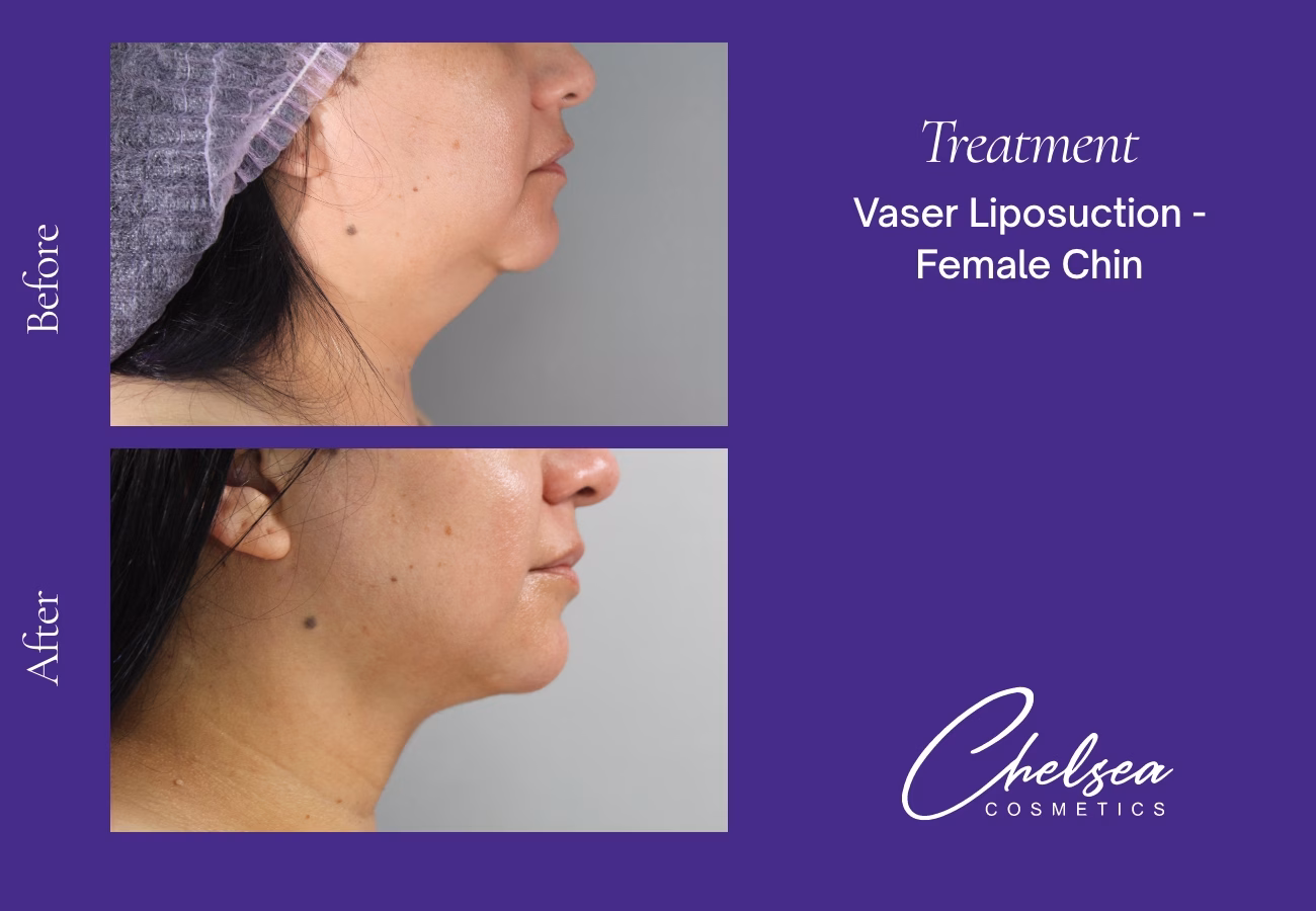 Chin Treatment — Chelsea Cosmetics Melbourne