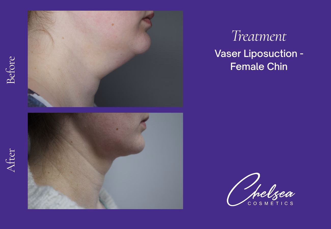 Chin Treatment — Chelsea Cosmetics Melbourne