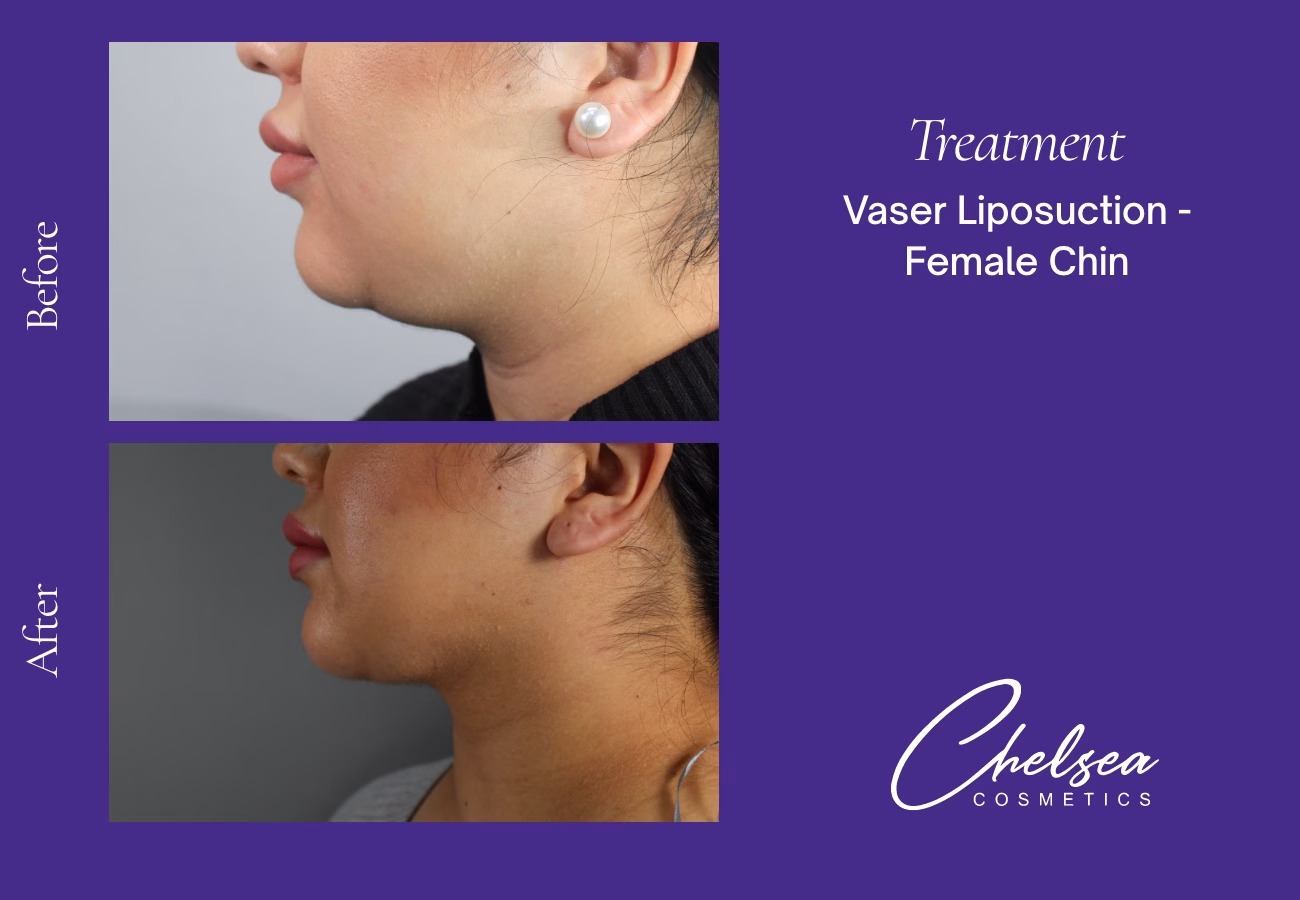 Chin Treatment — Chelsea Cosmetics Melbourne