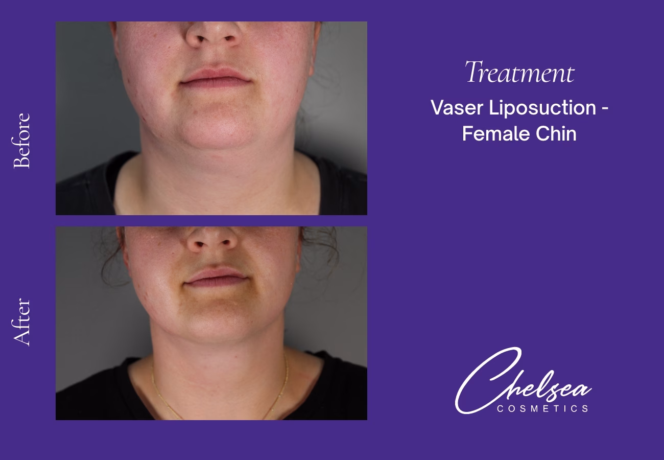 Chin Treatment — Chelsea Cosmetics Melbourne