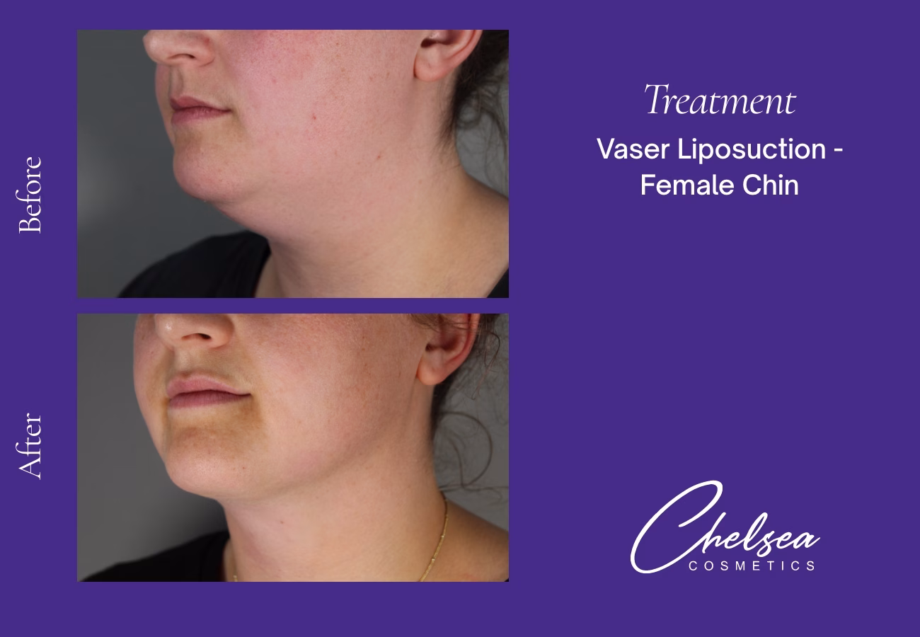 Chin Treatment — Chelsea Cosmetics Melbourne