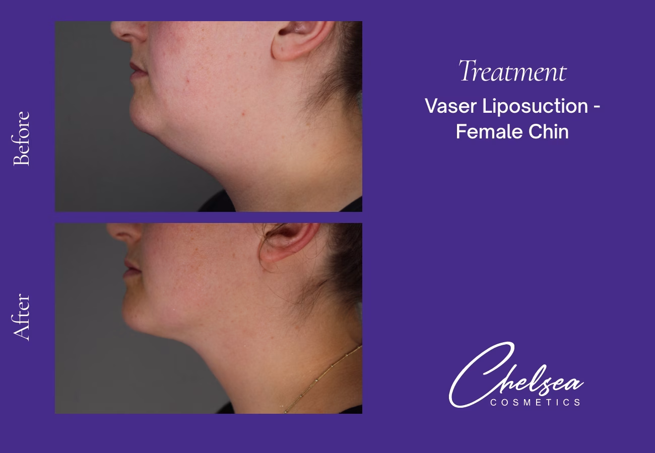 Chin Treatment — Chelsea Cosmetics Melbourne