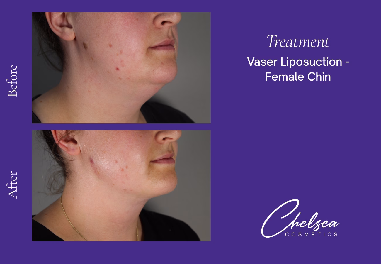 Chin Treatment — Chelsea Cosmetics Melbourne