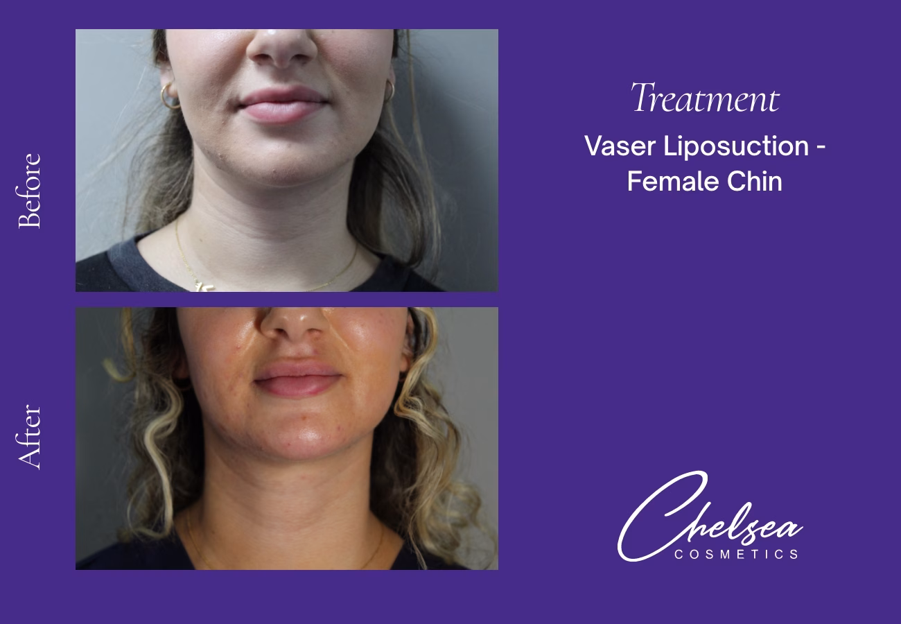 Chin Treatment — Chelsea Cosmetics Melbourne
