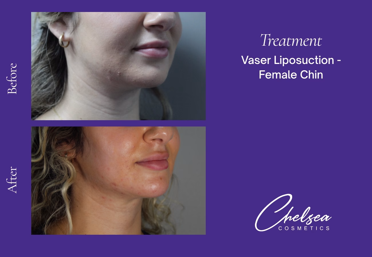 Chin Treatment — Chelsea Cosmetics Melbourne