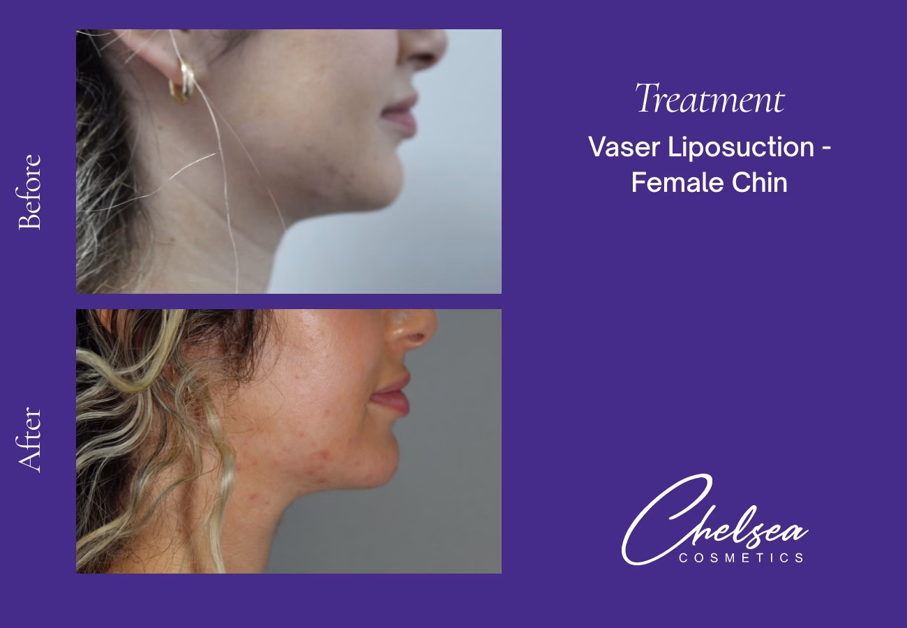 Chin Treatment — Chelsea Cosmetics Melbourne