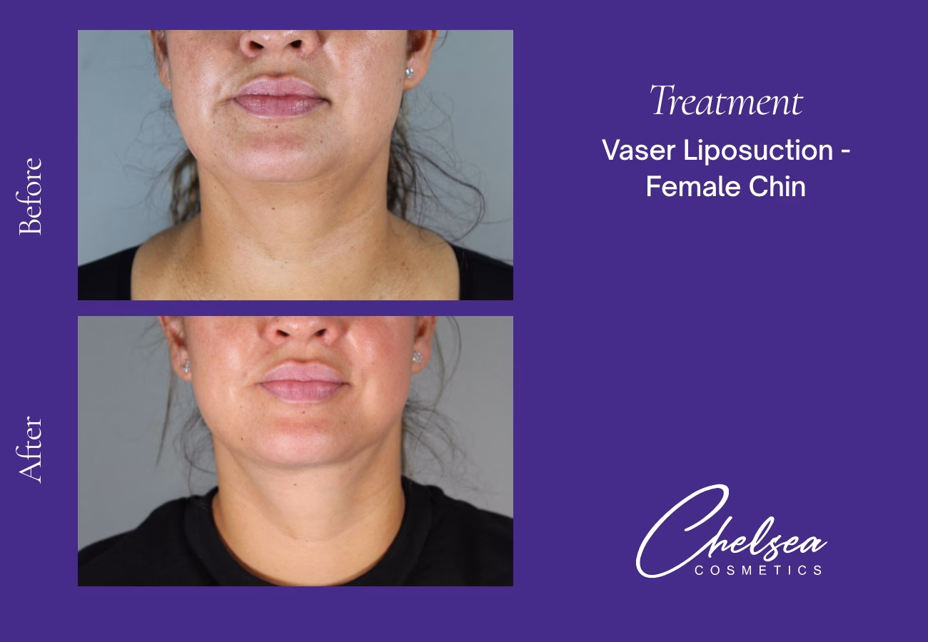 Chin Treatment — Chelsea Cosmetics Melbourne