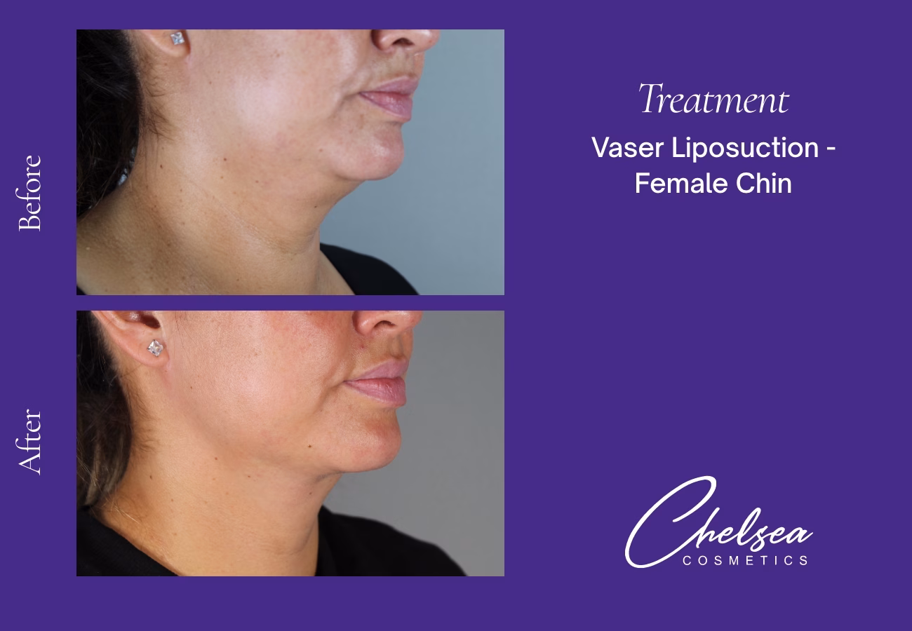 Chin Treatment — Chelsea Cosmetics Melbourne