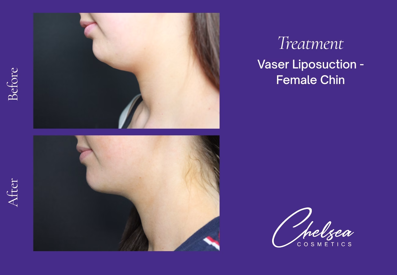 Chin Treatment — Chelsea Cosmetics Melbourne
