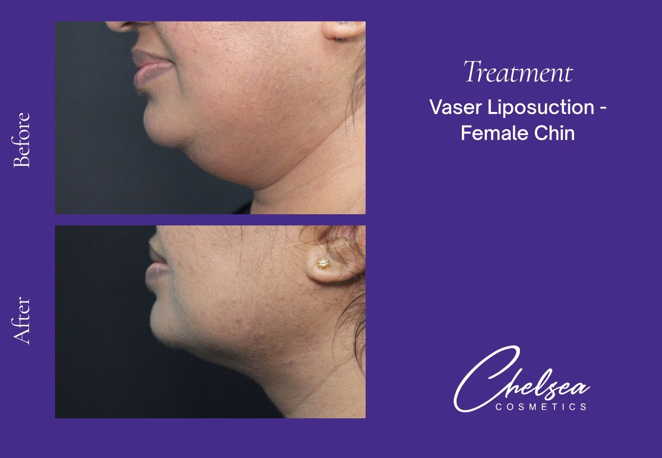 Chin Treatment — Chelsea Cosmetics Melbourne