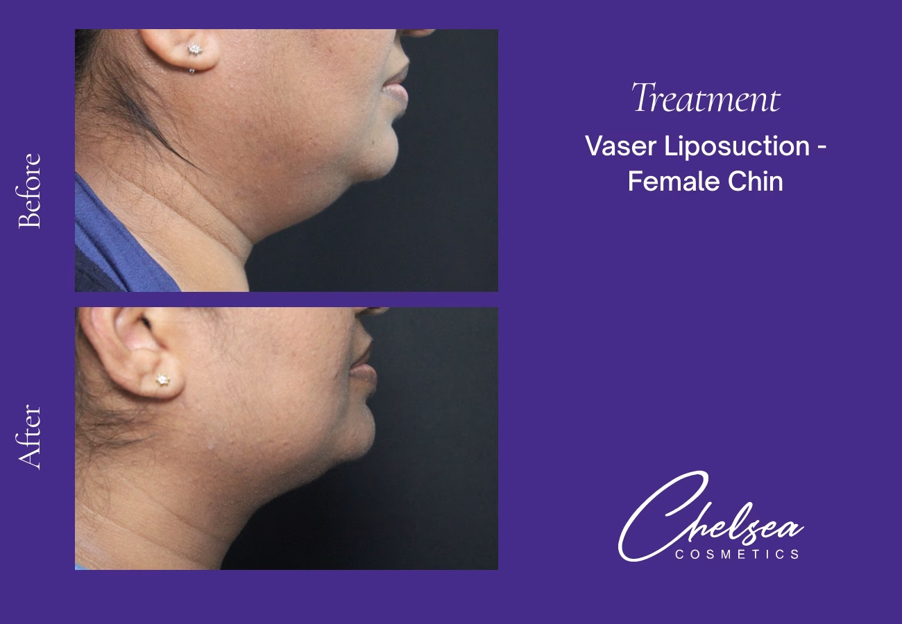 Chin Treatment — Chelsea Cosmetics Melbourne