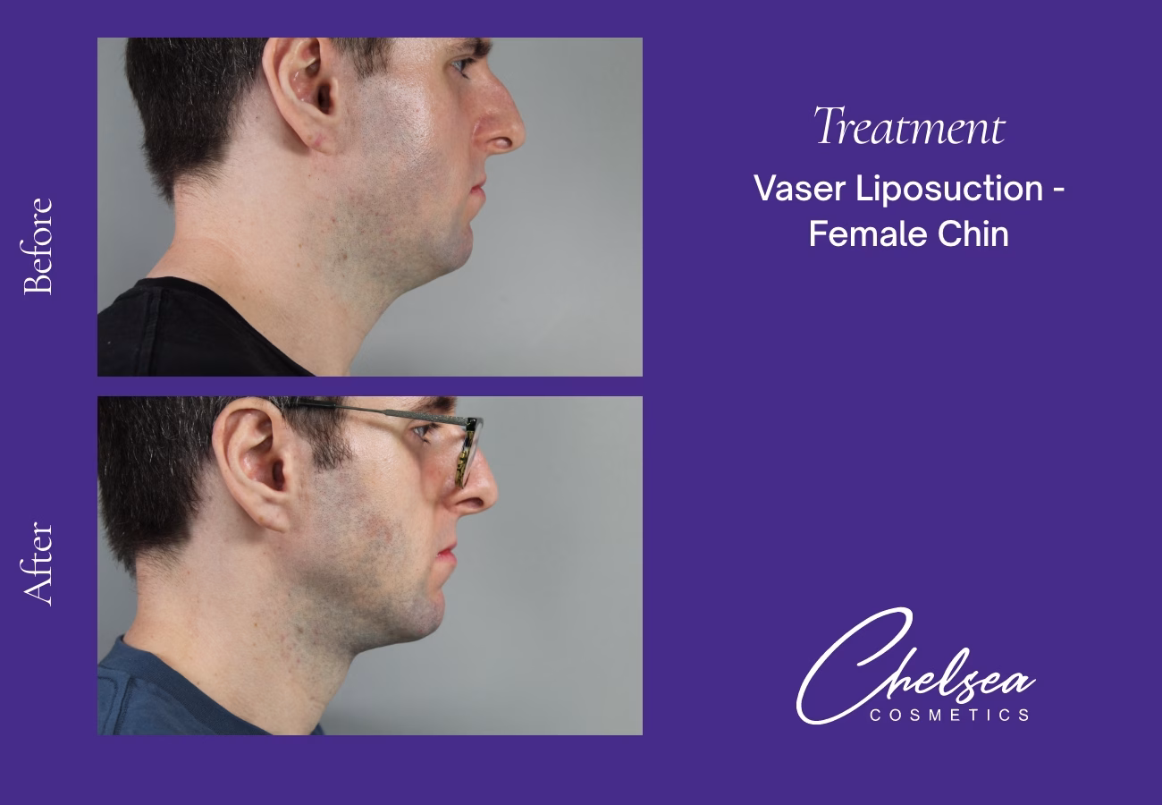 VASER Liposuction — Chelsea Cosmetics Melbourne