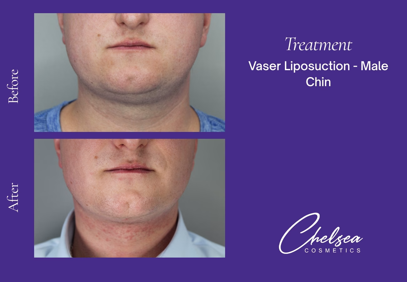 Chin Treatment — Chelsea Cosmetics Melbourne