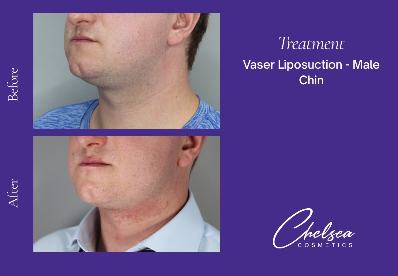 Chin Treatment — Chelsea Cosmetics Melbourne