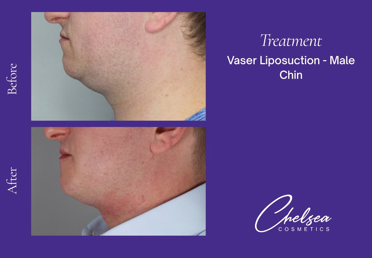Chin Treatment — Chelsea Cosmetics Melbourne