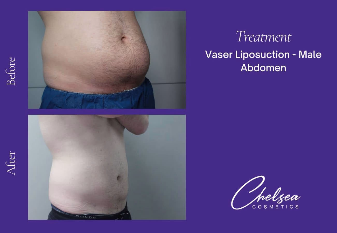 VASER Liposuction — Chelsea Cosmetics Melbourne