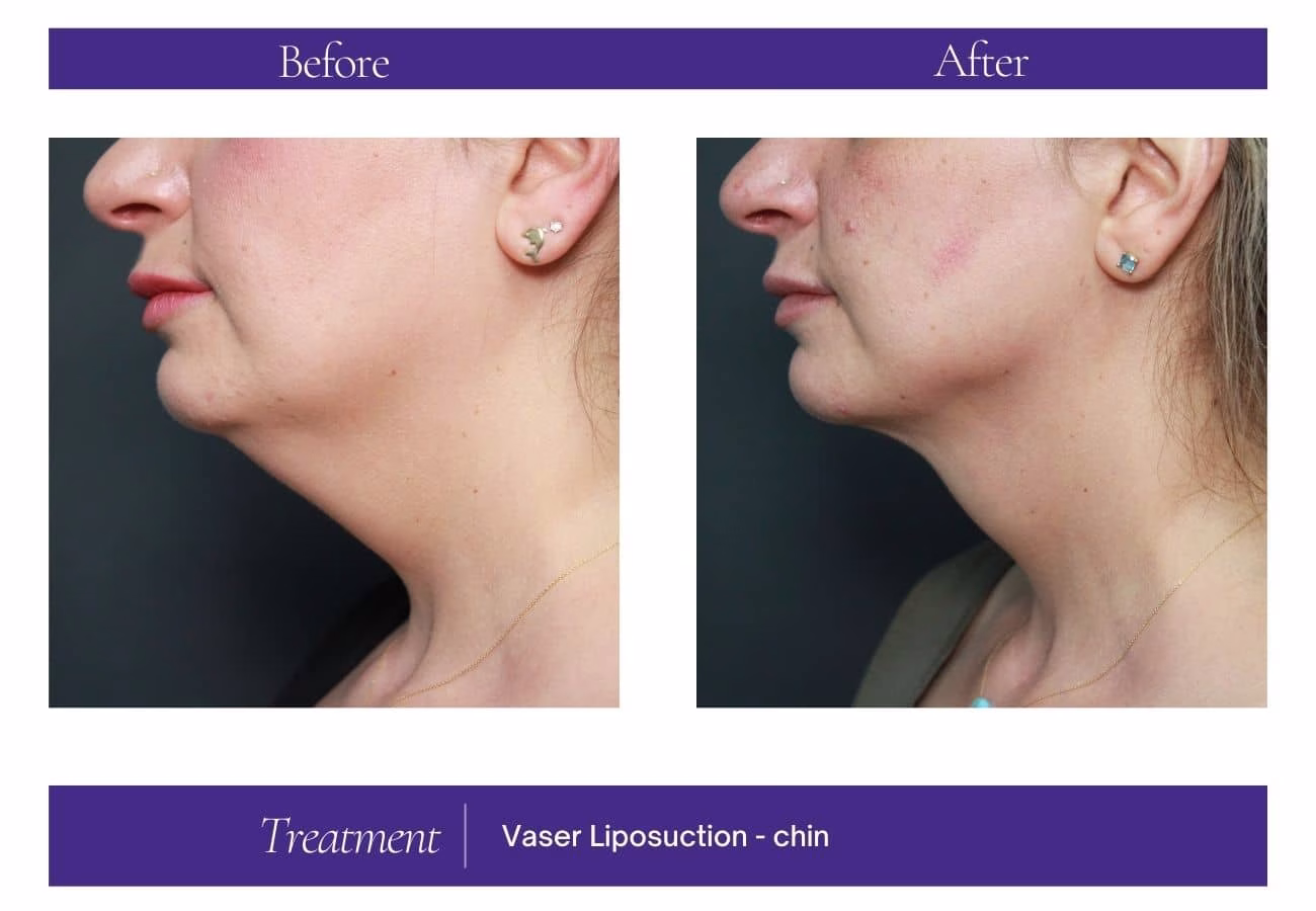 Chin Treatment — Chelsea Cosmetics Melbourne