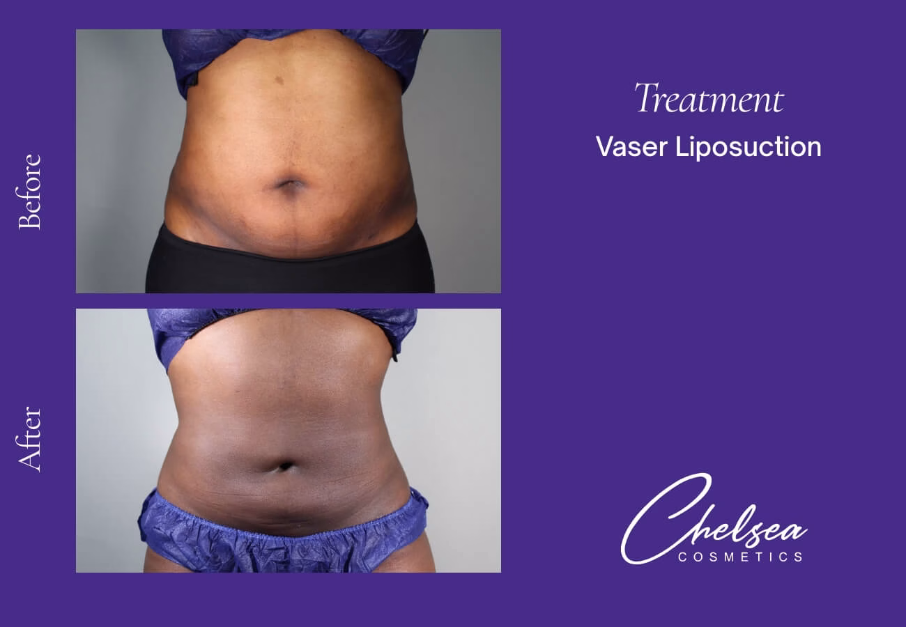 Liposuction — Chelsea Cosmetics Melbourne